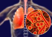 Tingkat Fatalitas Mycoplasma Pneumonia Lebih Rendah Dibanding COVID-19